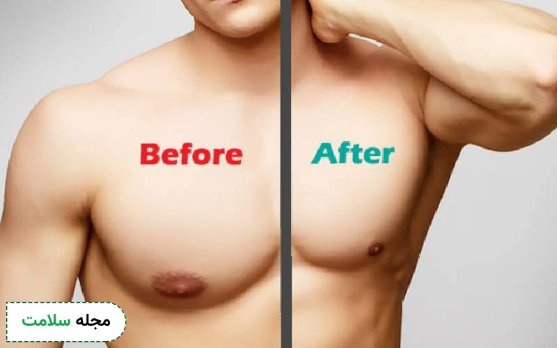 عمل ژنیکوماستی با لیزر چیست؟ | مزایا و عوارض لیزر ژنیکوماستی