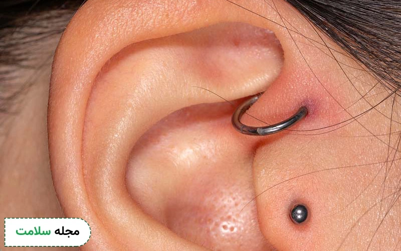 بعد از سوراخ کردن گوش بهویژه در قسمت غضروفی احتمال عفونت وجود دارد.