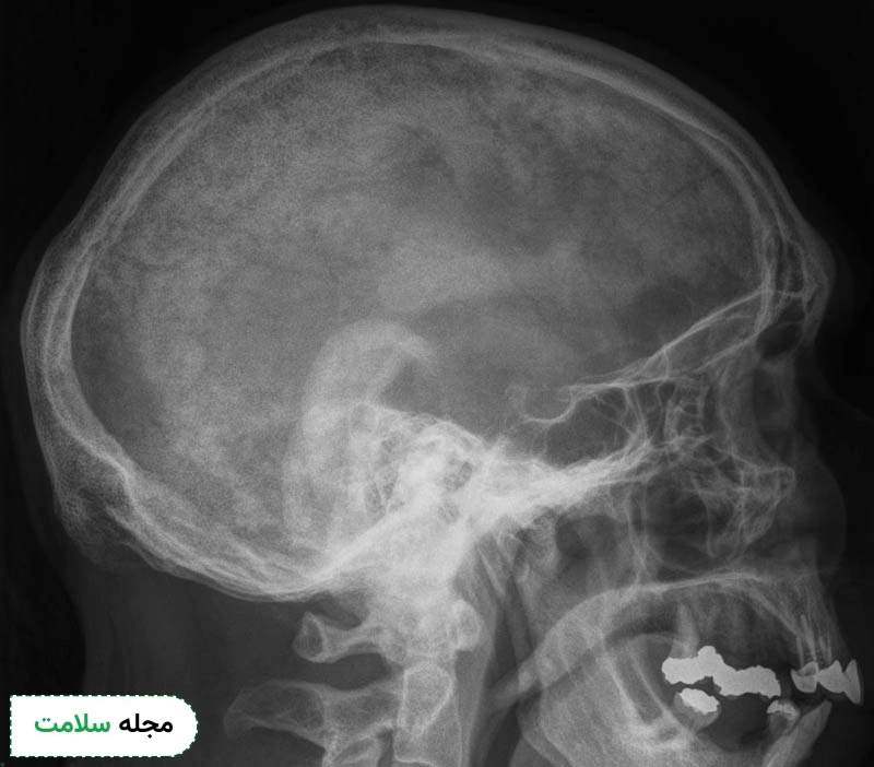 بیماری پاژه ممکن است استخوان جمجمه را تحت تاثیر قرار دهد.