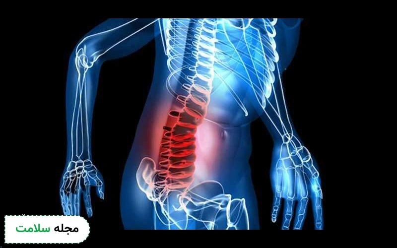 انحراف ستون فقرات چیست؟ معرفی بهترین ورزش برای انحراف ستون فقرات