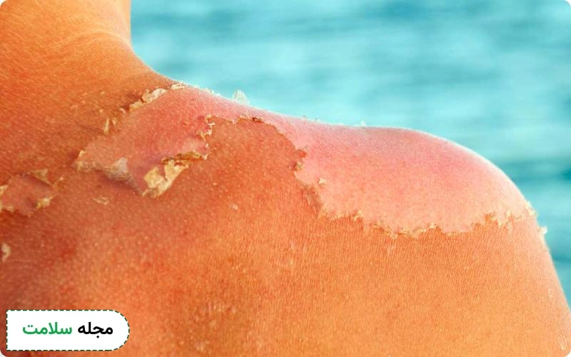 عوارض آفتاب سوختگی چیست؟