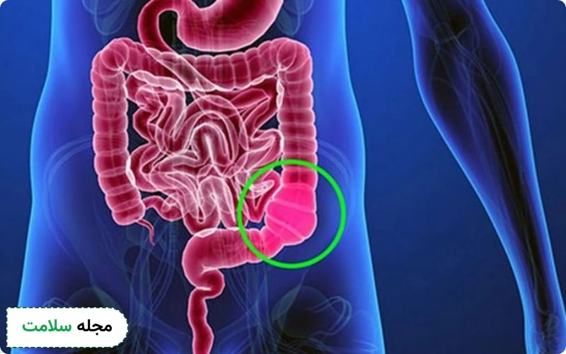 ازجمله علل تنبل‌شدن روده میتوان به بیماری هیرشپرونگ و انسداد روده اشاره کرد.