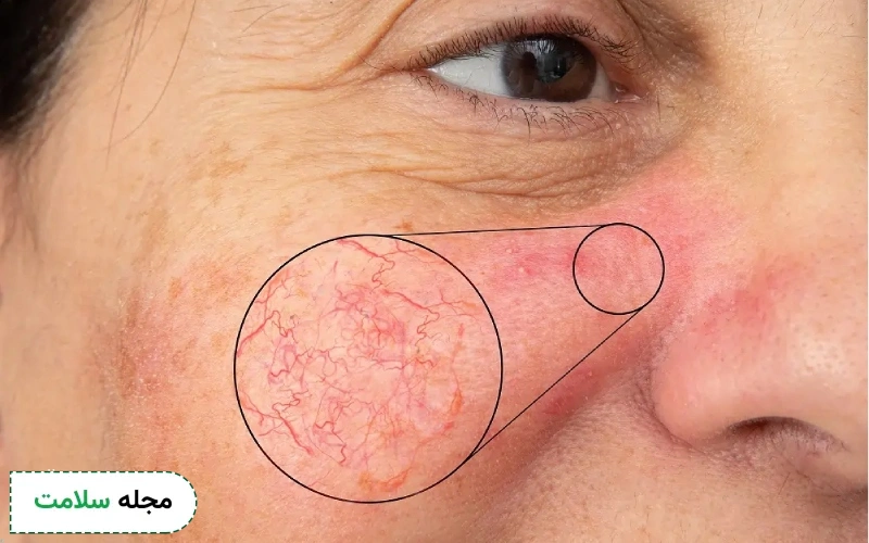 واریس صورت چیست و چگونه آن را درمان کنیم؟