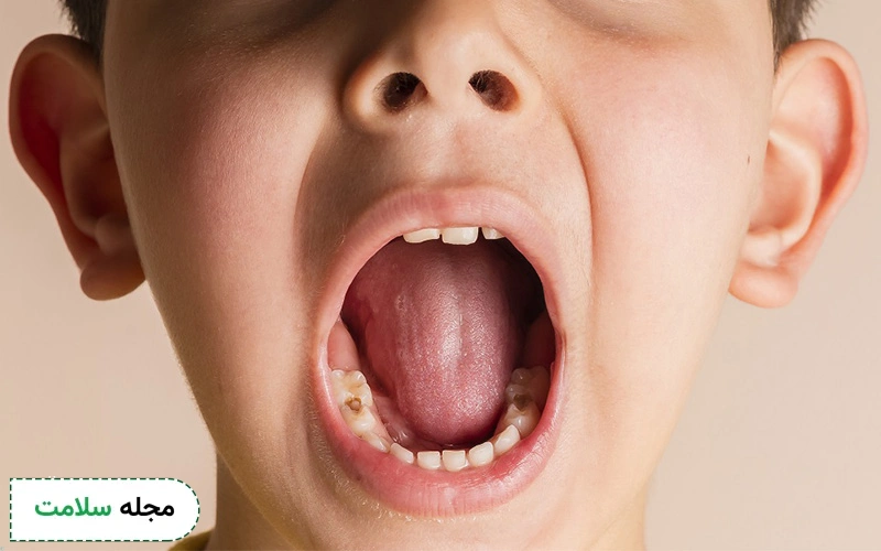 علت تحلیل لثه در کودکان چیست؟ چگونه می توان آن را درمان کرد؟
