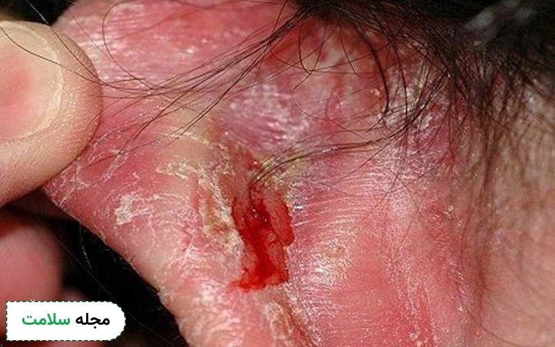 علل ابتلا به اگزمای لاله گوش