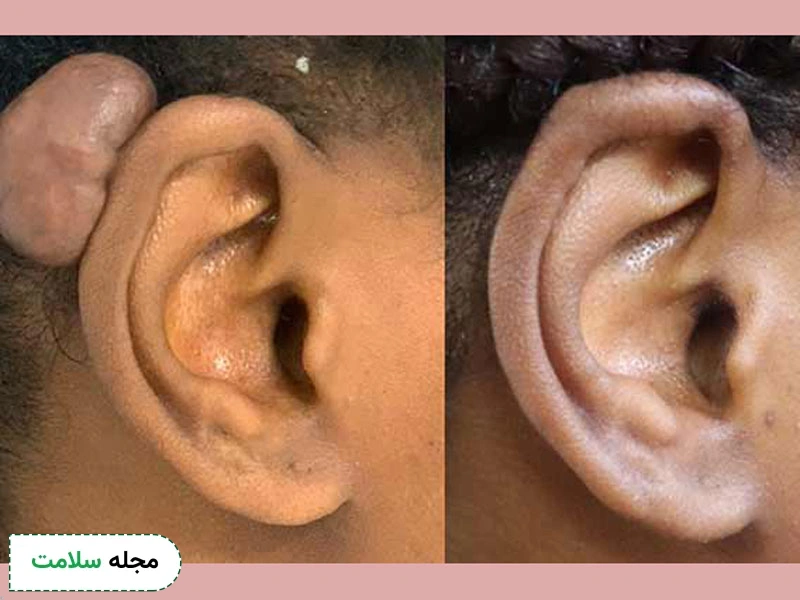 کلوئیدها میتوانند دردناک یا خارشدار باشند اما معمولا برای سلامتی فرد خطرناک نیستند.