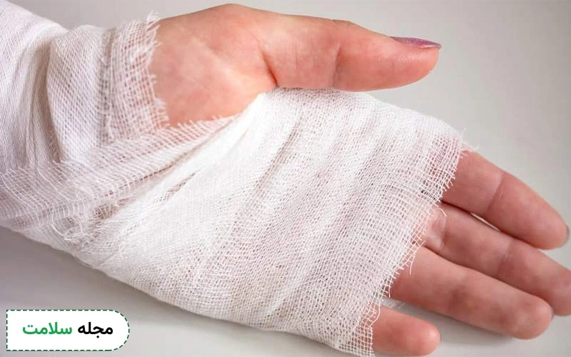 یک بانداژ تمیز روی ناحیه سوختگی از ایجاد عفونت جلوگیری میکند.
