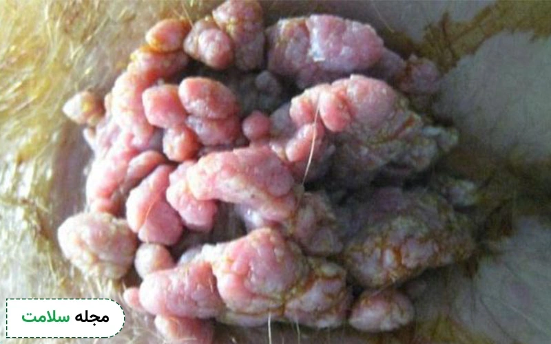 عوامل ریسک ابتلای مردان به HPV