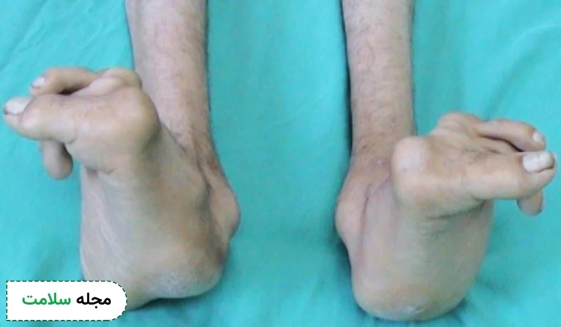 درصورتی‌که بیماری مدیریت نشود، ممکن است استخوان‌ها بدشکل شوند.