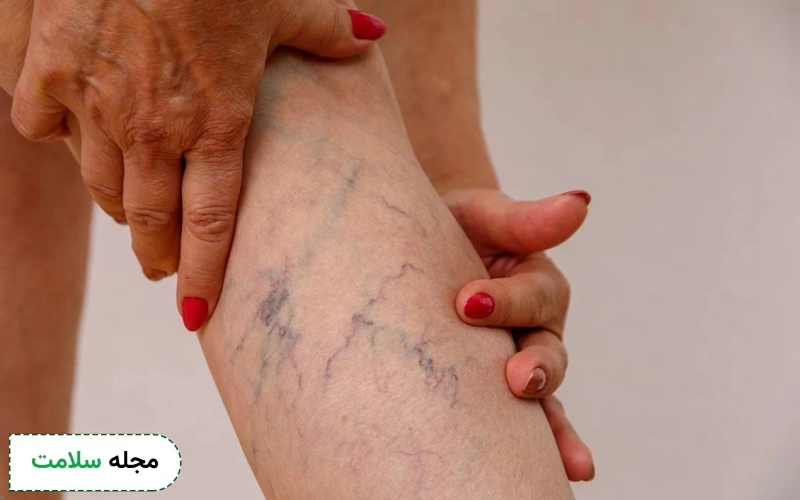 علت رگهای عنکبوتی پا