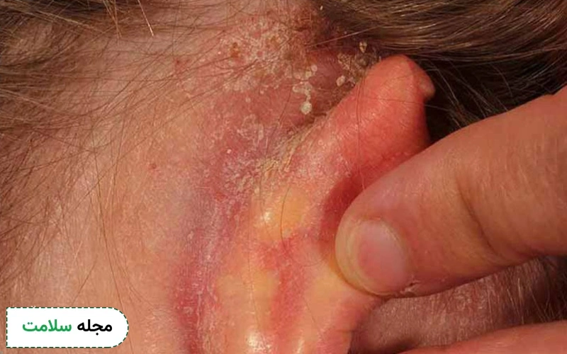 عوارض اگزمای لاله گوش