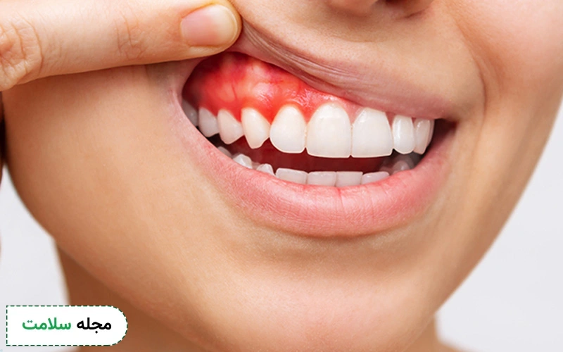 علت تحلیل لثه بعد از ایمپلنت چیست؟ آیا راه درمانی دارد؟
