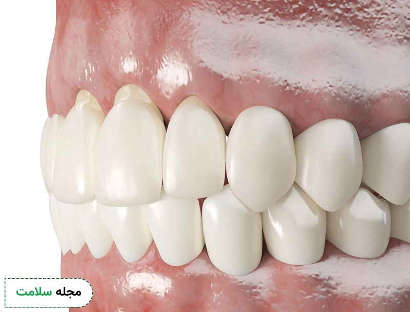 تحلیل لثه چیست و چقدر اهمیت دارد؟