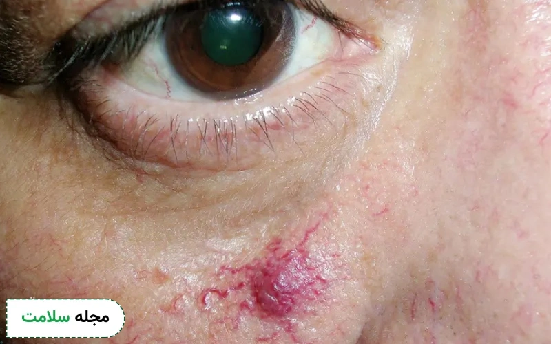 علت واریس صورت چیست؟