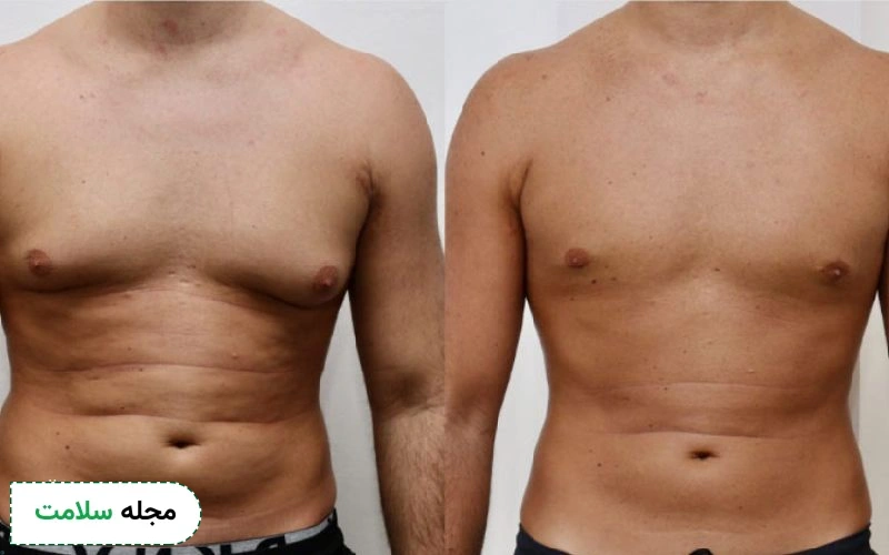 دوره نقاهت عمل ژنیکوماستی