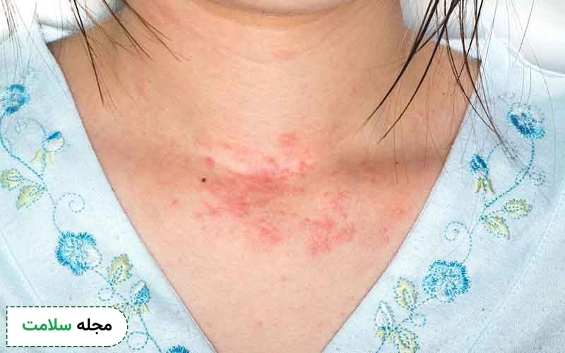 آیا زونا خطرناک است؟ عوارض این بیماری برای کودکان، زنان، مردان و افراد مسن