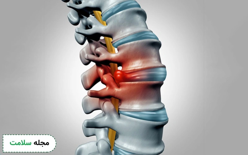 تنگی کانال نخاع؛ دلایل ایجاد و روش پیشگیری آن چیست؟