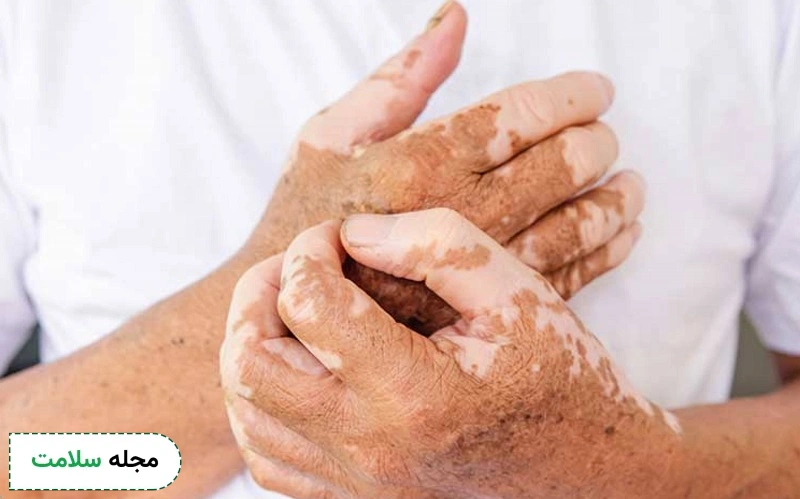 علائم اصلی این بیماری تغییر رنگ پوست است.