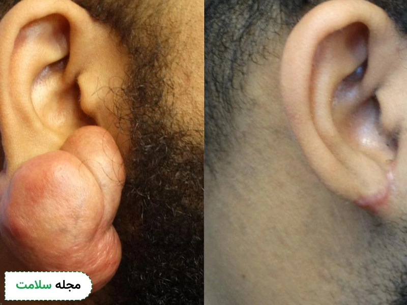 کلوئید گوش چه نشانه هایی دارد؟ چگونه آن را از بین ببریم؟