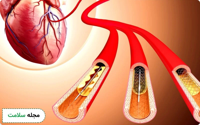 آنژیوپلاستی چگونه انجام میشود؟