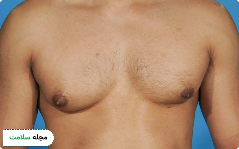 انواع ژنیکوماستی - ژنیکوماستی مادرزادی