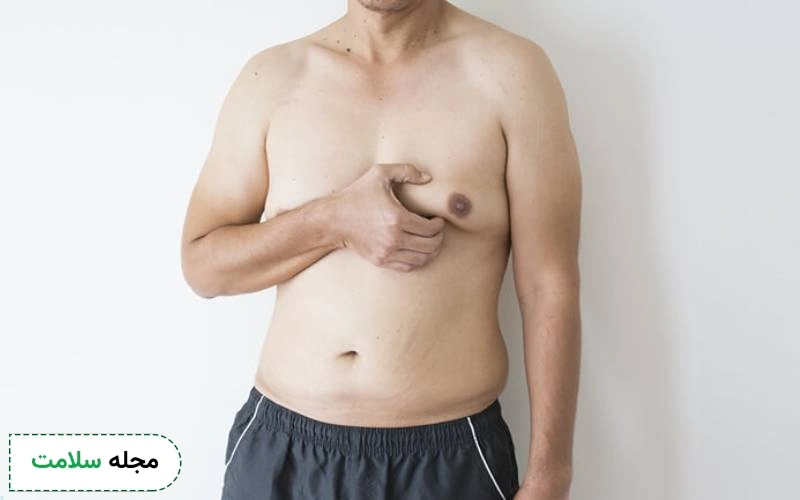 ژنیکوماستی شدید چه علائمی دارد؟ علل و راه های درمان آن