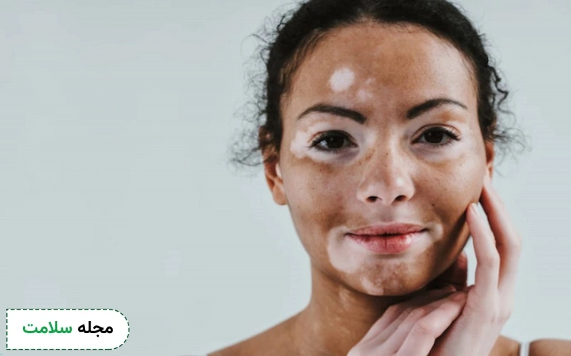 علائم پیسی؛ چطور پیسی را در مراحل ابتدایی تشخیص دهیم؟ – مجله سلامت دکترتو