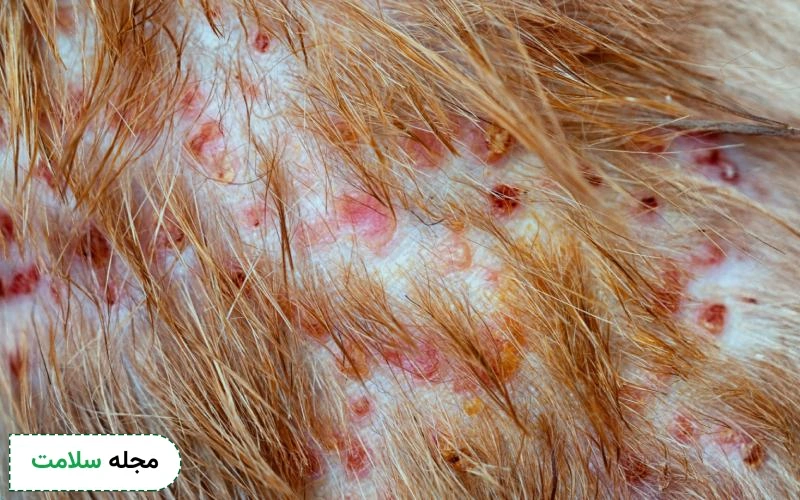 فولیکولیت بعد از کاشت مو و ابرو چه دلیلی دارد؟