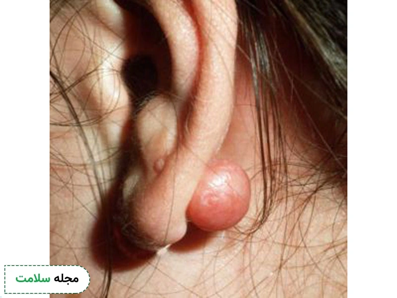 چه کسانی به کلوئید گوش مبتلا میشوند؟