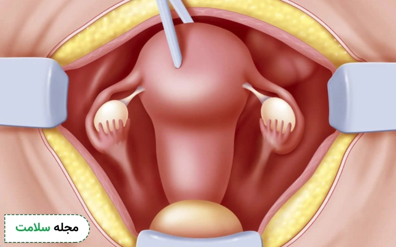 قبل از تصمیم به عمل هیسترکتومی (برداشتن رحم) این نکات را بدانید – مجله سلامت دکترتو