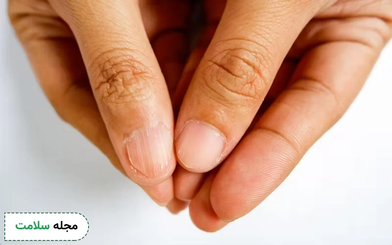 علائم کمبود اهن در ناخن
