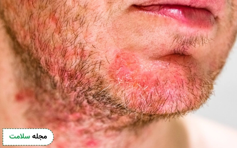 علل فولیکولیت مو چیست؟