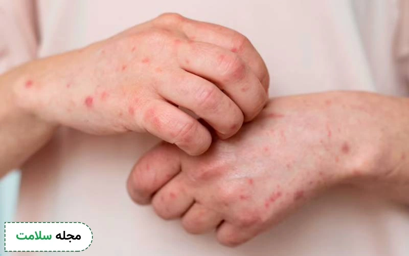 آیا زونا و سرطان با هم مرتبط هستند؟ زونا چه ارتباطی با سلول های بدخیم دارد؟