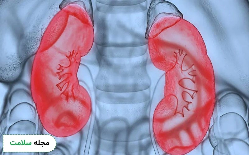 سندروم نفروتیک کلیه و روش های درمان آن