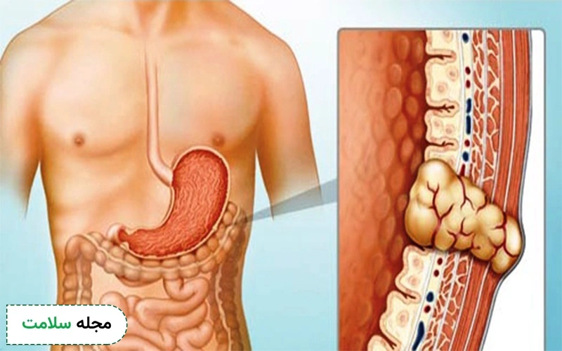 تومور استرومال از سلولهای عصبی به نام سلولهای بینابینی شروع میشود.