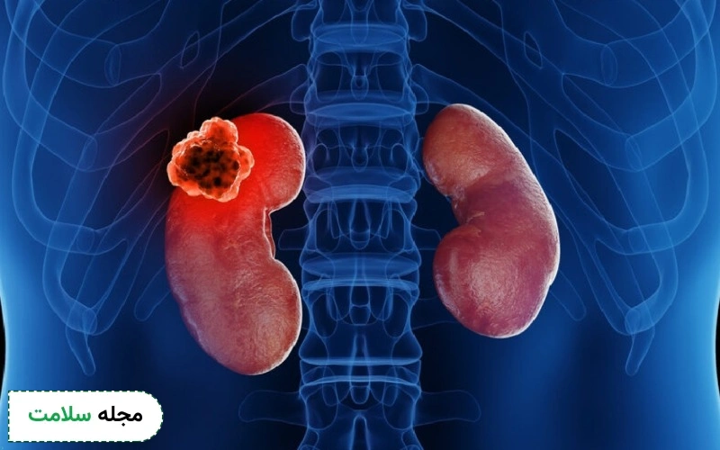 علائم و روش تشخیص کارسینوم کلیه (RCC)، آیا هایپرنفروم قابل درمان است؟