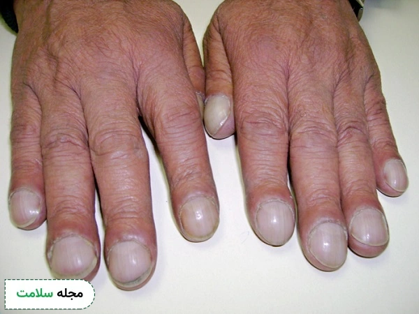 یکی از علائم بیماری ریه ناخن های کلابینگ است.