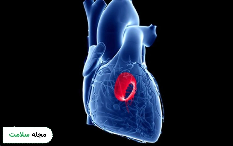افتادگی دریچه میترال چیست و چگونه درمان می شود؟
