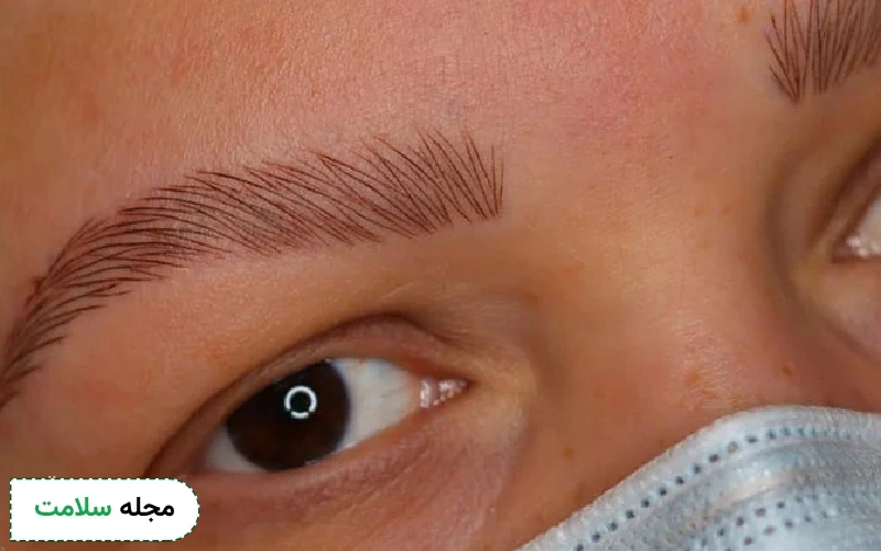 میکروبلیدینگ برای کاور ریزش ابروی گسترده
