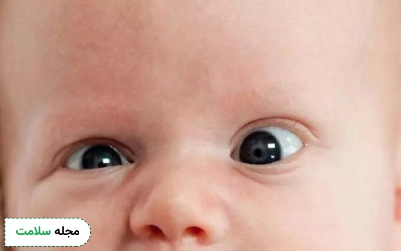 عکس انحراف چشم نوزاد