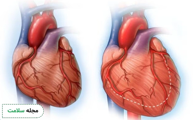 بزرگ شدن قلب چیست و چگونه رخ میدهد؟