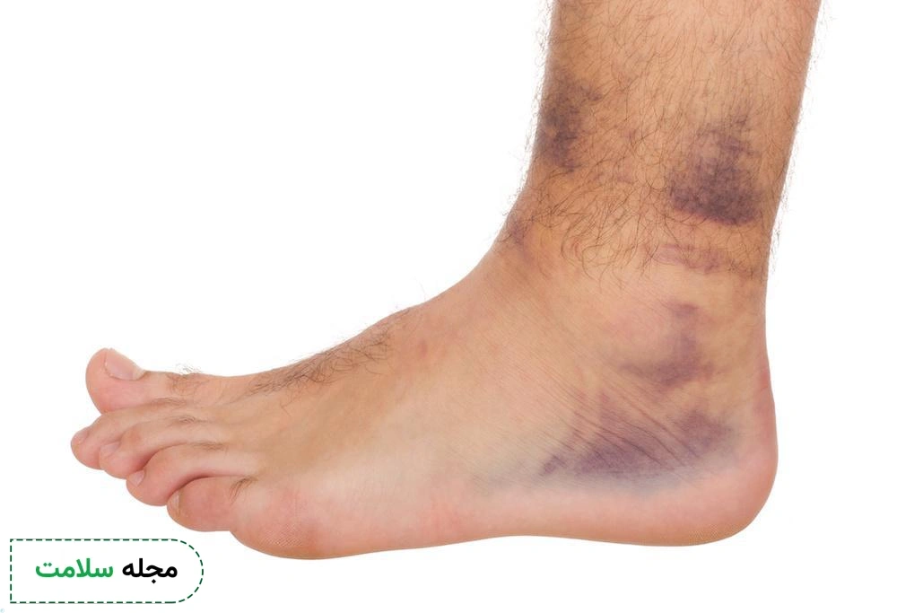 علائم رگ به رگ شدن پا چیست؟