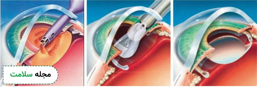 iol Implants surgery