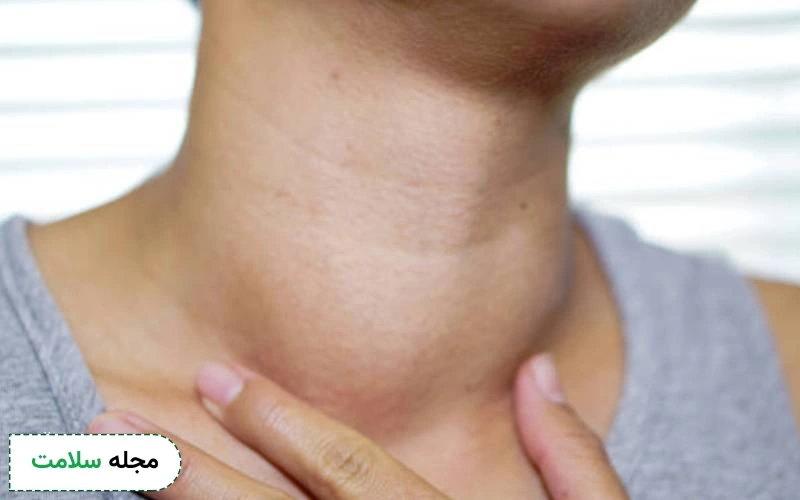 همه چیز در مورد گواتر یا بزرگی غده تیروئید