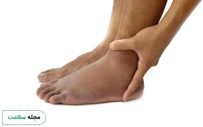 علت رگ ب رگ شدن پا چیست؟