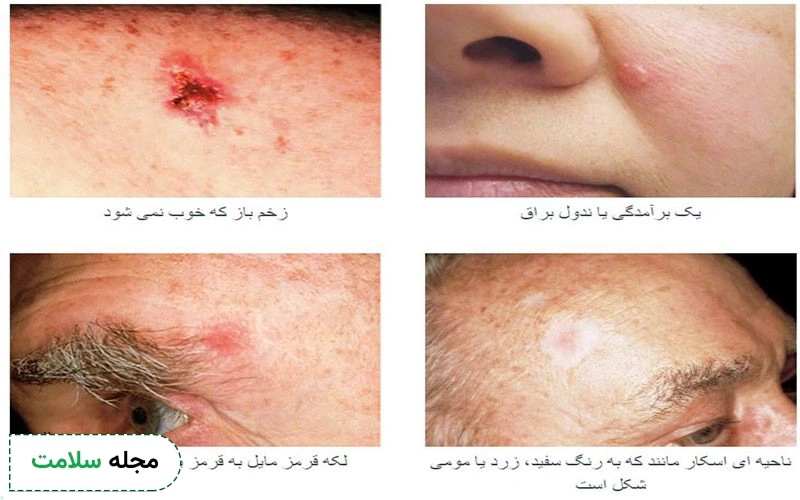 عکس سرطان سلول بازال روی صورت