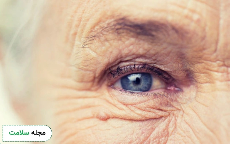 همه چیز درباره دژنراسیون شبکیه چشم؛ علل، علائم و درمان آن