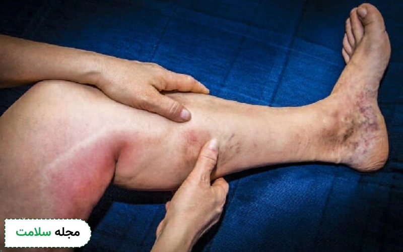 علائم ترومبوز سیاهرگ عمقی؛ علل و راه های درمان DVT