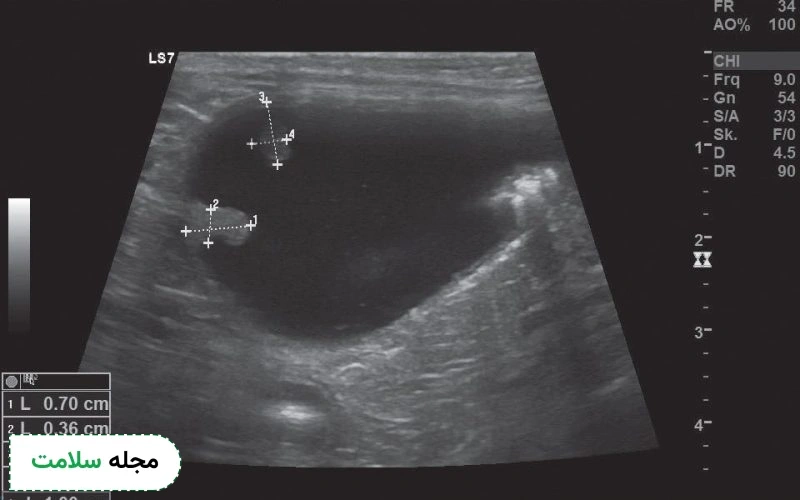bladder polyp