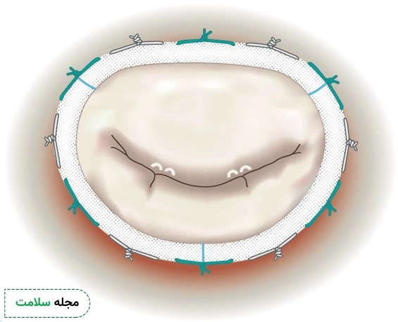 جراحبی دریچه میترال قلب